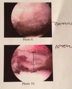 bone-spur - TrainingBeta